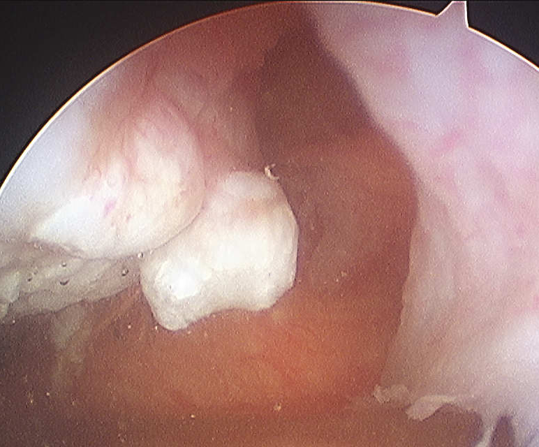 Patella Dislocation MPFL Disruption Patella Arthroscopy